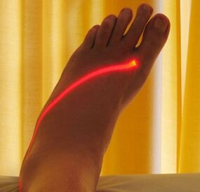 lasersko zdravljenje krčnih žil na nogah