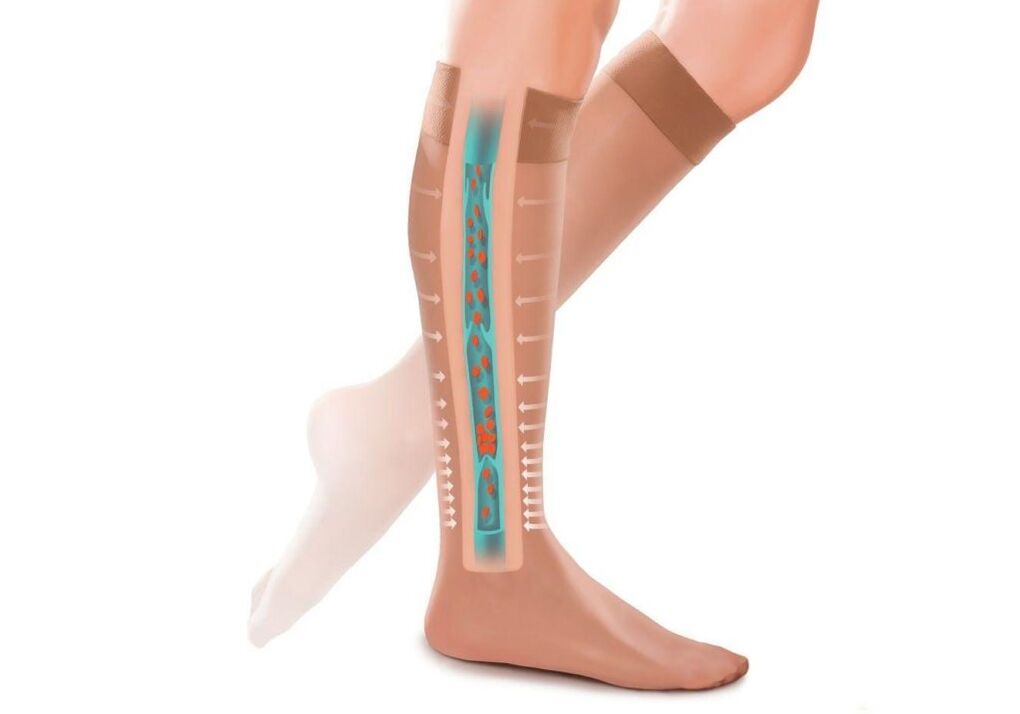učinek kompresijskih nogavic na nogah s krčnimi žilami
