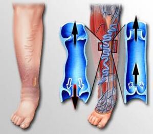 pretok krvi v nogi s krčnimi žilami