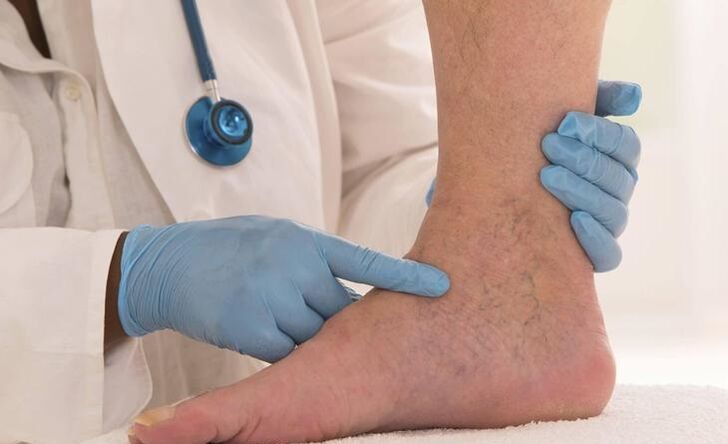 zdravnik pregleda nogo z krčnimi žilami