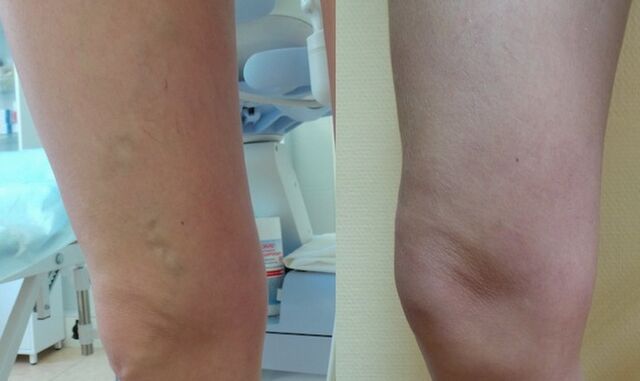 nog pred in po zdravljenju retikularnih krčnih žil