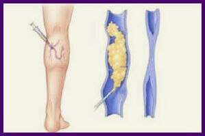 Skleroterapija je priljubljena metoda za odpravo krčnih žil na nogah