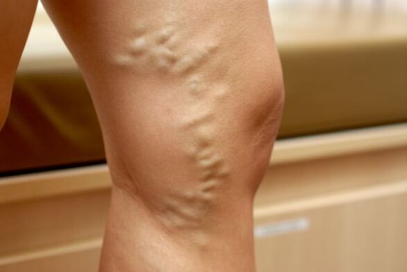 krčne žile na nogi s krčnimi žilami majhne medenice
