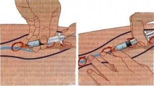 metode zdravljenja krčnih žil
