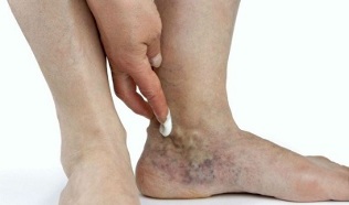 manifestacije krčnih žil na nogah
