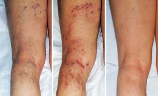 simptomi krčnih žil na nogah