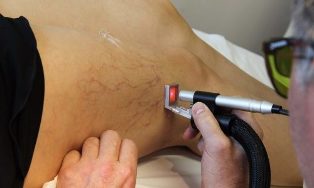zdravljenje krčnih žil laser