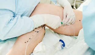 metode zdravljenja krčnih žil na nogah pri ženskah