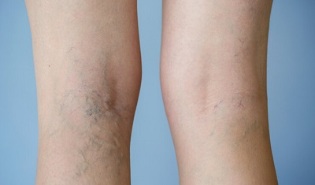 znaki krčnih žil na nogah pri ženskah