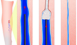 Uvedba sclerosant med sclerotherapy